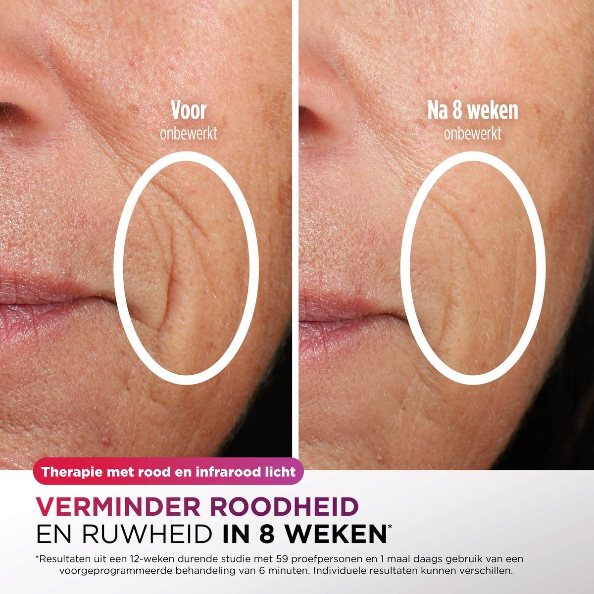 Shark CryoGlow LED Gezichtsmasker - FW312EUPL